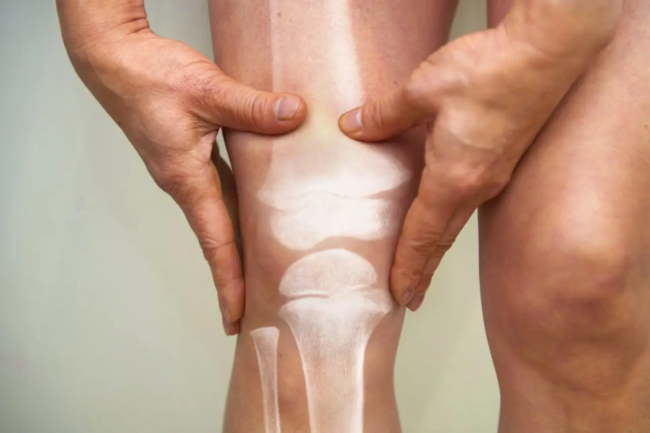 Attenzione a questa terapia comune: se hai l’osteoporosi è assolutamente controindicata