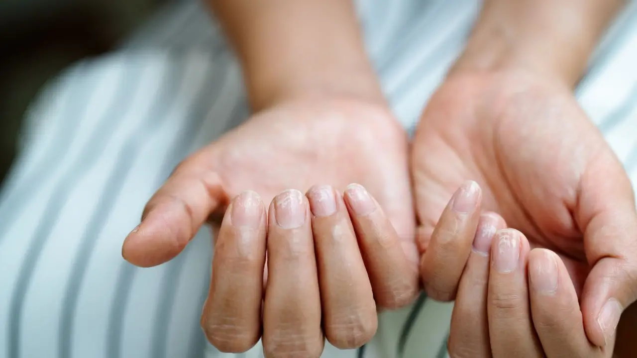 Cosa significano le macchie bianche sulle unghie? Ecco cosa ti sta comunicando il tuo corpo